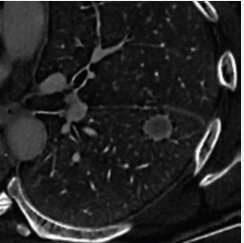 双能CT碘浓度可区分肺癌和肺转移瘤