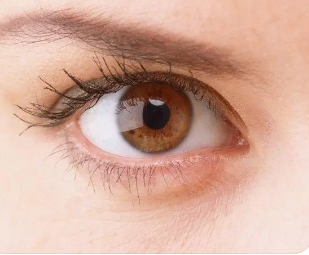 虹膜炎是虹膜发生炎症的一种眼部疾病