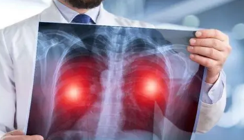 肺癌的15个征兆早期到晚期