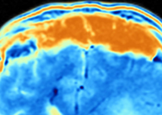 限制蛋氨酸可使患有侵袭性脑癌的小鼠寿命延长50%